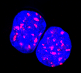 Persistent DNA damage, visualized by gammaH2AX staining (red dots), in hematopoietic stem cells could lead to leukaemia