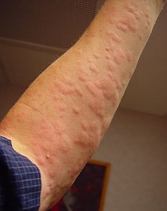 Good news for chronic idiopathic urticaria patients - Genentech phase III omalizumab trial has shown success in reducing disease severity