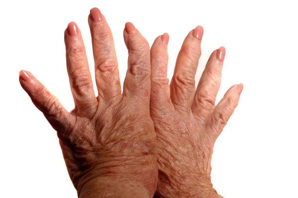 Gout therapeutics market grew at a compound annual growth rate of 13.4 percent between 2006 and 2011