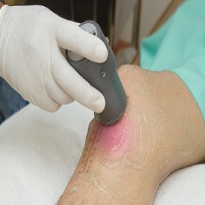 Neridronic acid is the only approved therapeutic drug for osteogenesis till date