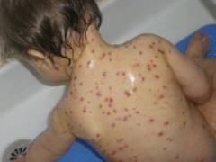 Measles claimed 158,000 lives in 2011 - CDC