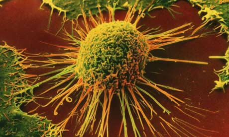 Radiation therapy transforms breast cancer cells into treatment resistant cancer stem cells