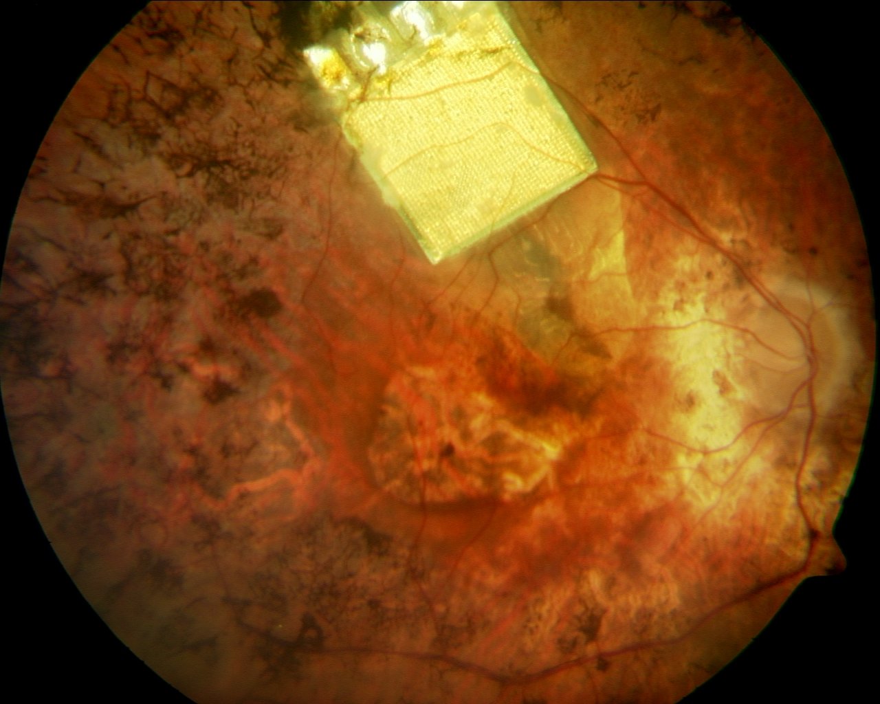 The retina implant uses electrodes on the chip to absorb light entering the eye and converts it into electrical energy to stimulate nerves within the retina