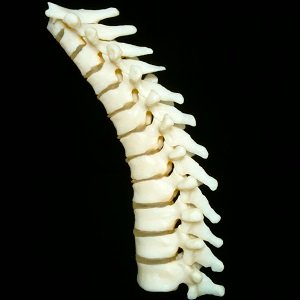 3D-printed vertebra offered much greater customization and comfortable recovery